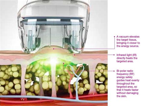 VelaShape3 Technology .